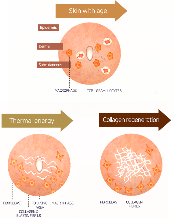 Collagen regeneration principle